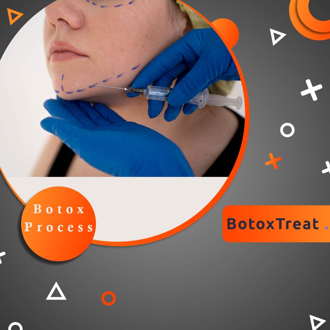 BotoxTreat Botox Process